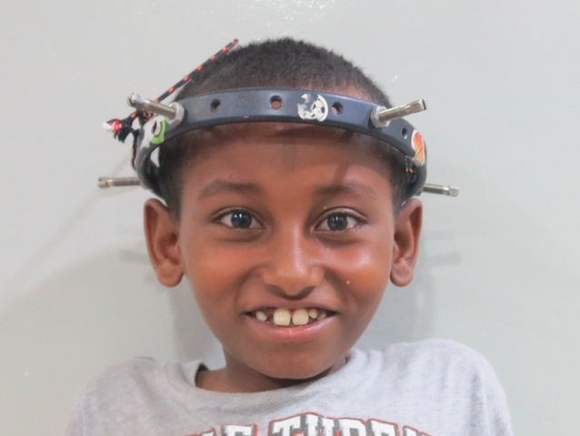 Mengistu is a young boy from Ethiopia who needs $1,500 so he can walk normally and live without pain.